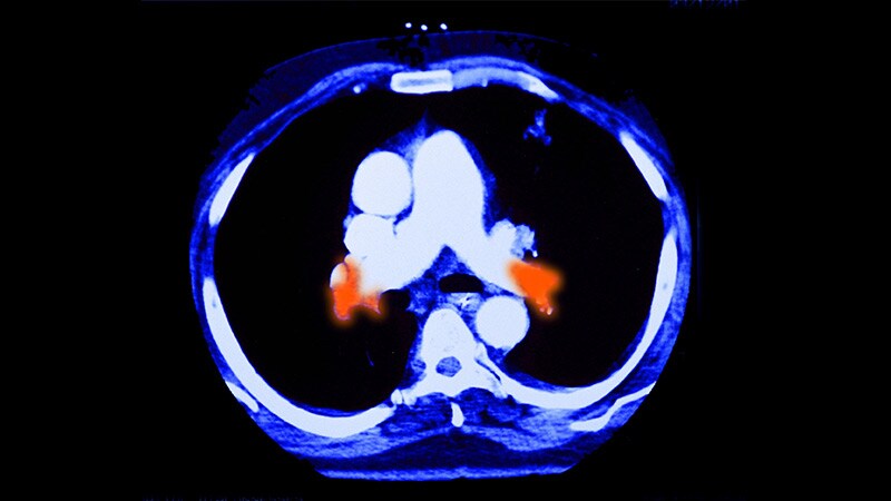 Positive Data on Lytic-Avoiding PE Thrombectomy Catheter
