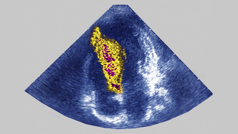 Myosin Inhibitor Boosts QoL, Eases Symptoms in Obstructive HCM 