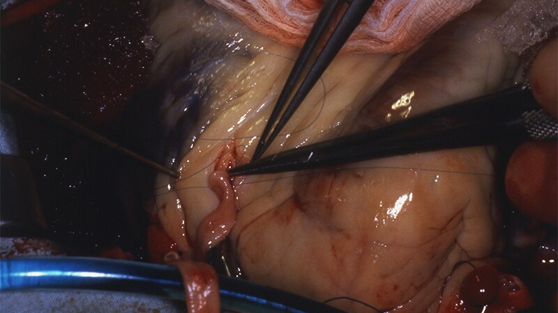Neurotoxin to Avert Postoperative AF: Patient Selection Clues in NOVA