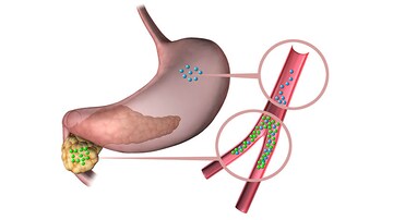 Fast Five Quiz: Assessing and Advancing Therapy for T2D