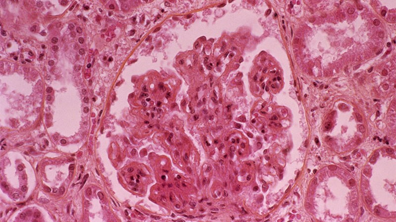 Lupus Nephritis Treatment Response Biomarkers Gain Ground