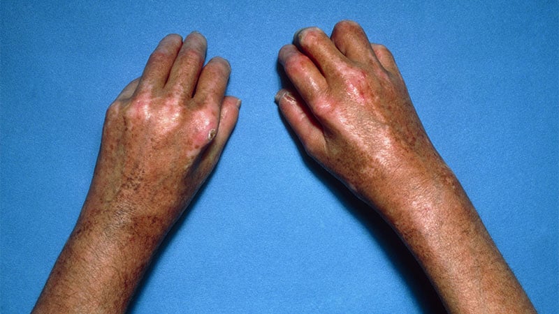 Lupus May Overlap in Many Patients With Systemic Sclerosis