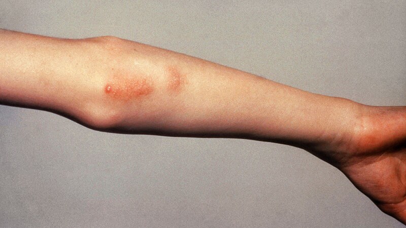 Systemic JIA and AOSD Are the Same Disease, EULAR Says