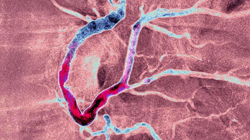 FIRE a Win in MI Physiology-Based Complete Revascularization