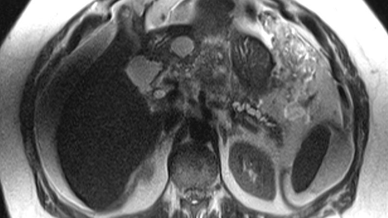 A Woman With Worsening Abdominal Pain and Nausea Despite Antacid Use