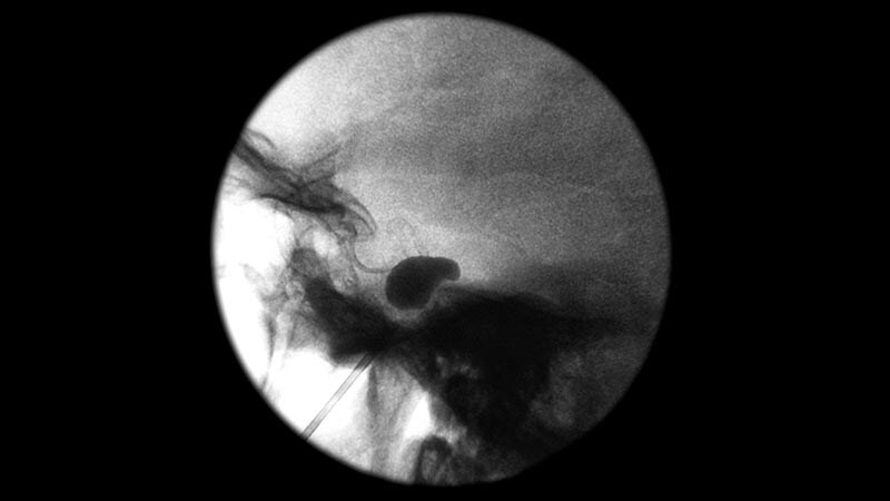 Irritability, Headaches, and Weight Loss