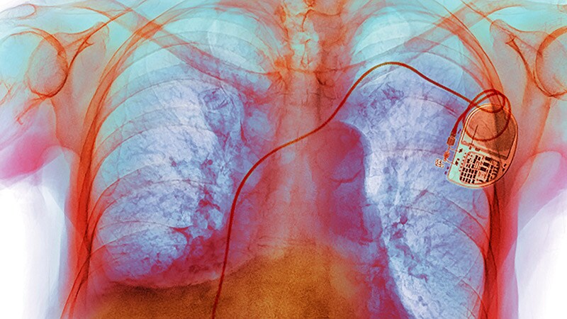 Fast Five Quiz: Risk Factors for Heart Failure