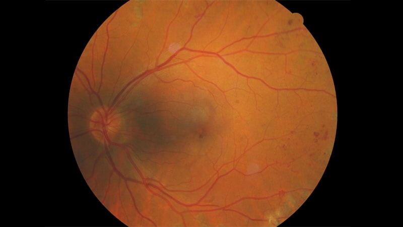 GLP-1s Don't Appear to Worsen Diabetic Retinopathy