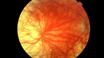 Researchers Pinpoint Causes of Foveal Hypoplasia