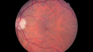 Radiation Retinopathy: Treat-and-Extend Promising