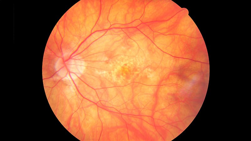 Complications From Geographic Atrophy Drug Fuel Questions