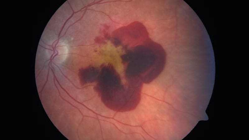 High-Dose Aflibercept Sustains Outcomes Over 96 Weeks