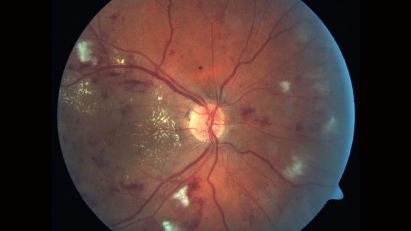 Implant Shown to Lower Anti-VEGF Burden in DME