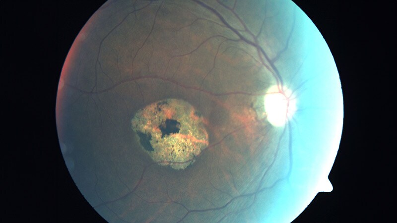 Oral Therapy Shown to Preserve Retina in Stargardt Disease