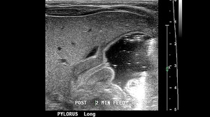 11 Infant Abdominal Emergencies