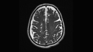 Multiple Sclerosis: Making the Diagnosis With MRI
