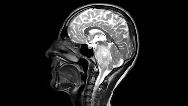 Palliative Radiation Therapy Improves QoL in HG Glioma