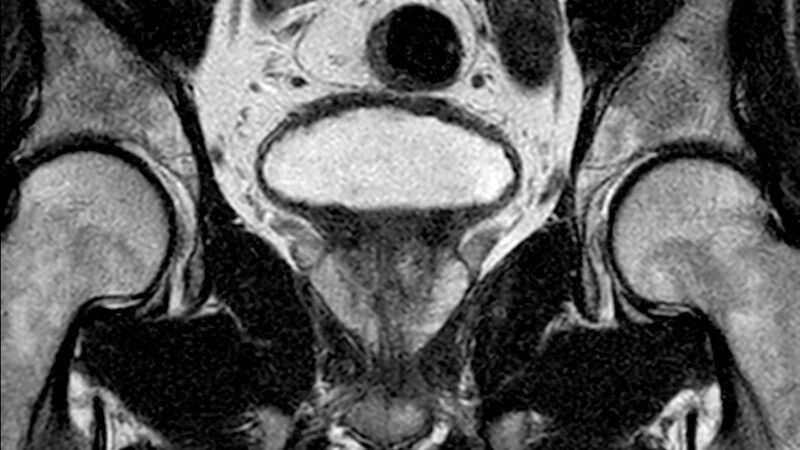 Is This the Best Screening Test for Prostate Cancer?