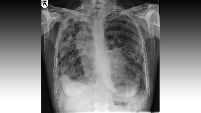 5-Year Outcomes for Bronchiectasis, NTM Nearly Identical 
