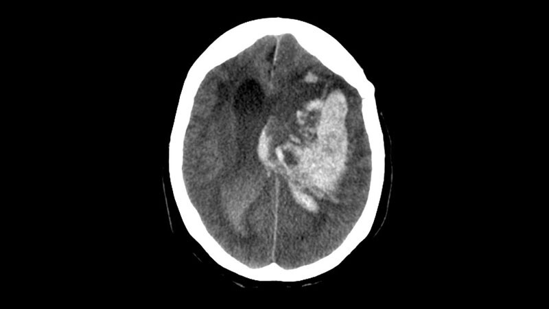 Care Bundle Improves Outcome in ICH: INTERACT3