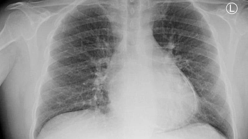 RHAPSODY: Rilonacept Resolves, Prevents Pericarditis Recurrence