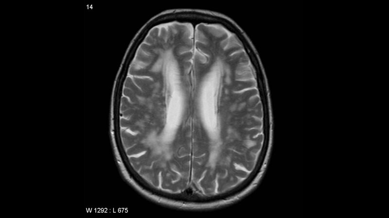 No Reduction in WMH Progression With Allopurinol After Stroke