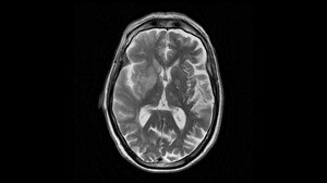 Tenecteplase Non-inferior to Alteplase in Stroke: ATTEST-2