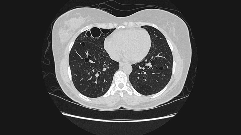 Race-Specific Lung-Function Values May Skew IPF Testing