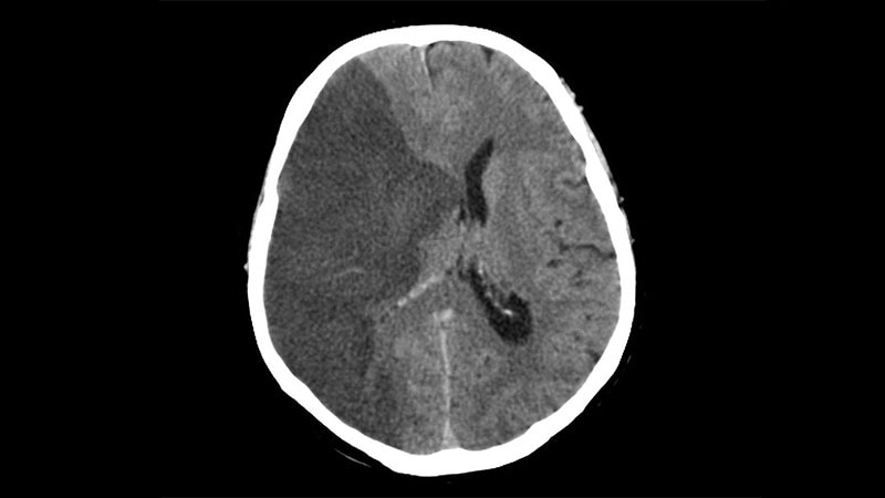 Tenecteplase Noninferior to Alteplase for Ischemic Stroke: TRACE-2