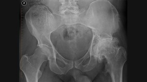 HSS, Arthritis Foundation Spotlight Neglected Hip OA Research
