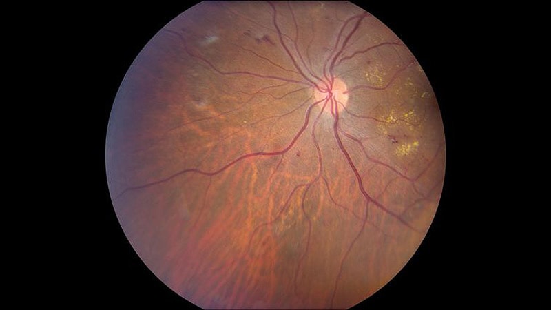 Study Shows Tarcocimab May Improve Diabetic Retinopathy  