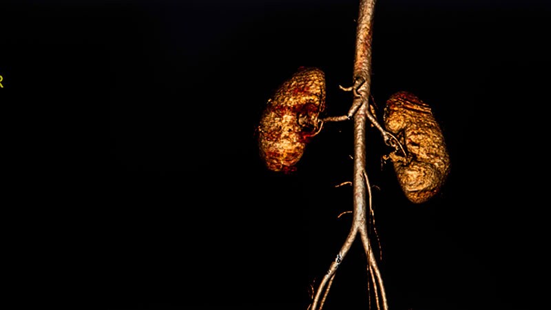 Renal Denervation Adds Clout to Multiple Meds in Resistant HTN