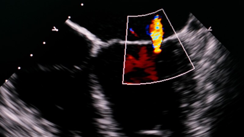 COAPT 5-Year Results 'Remarkable' but Selection Issues Remain