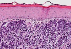 Skin Cancer - Merkel Cell Carcinoma: Background, History of the Procedure, Problem
