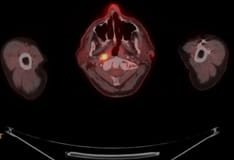 Cervical most cancers remedy Protocols Medscape