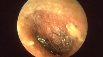 Pneumonia Shows Strong Connection to Chronic Otitis Media
