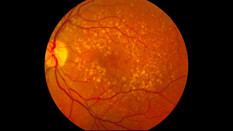 Study Shows Vision, Anatomy Stable With Port System for AMD