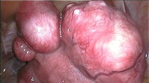 Relugolix Combo Effective for Uterine Fibroids Through 1 Year