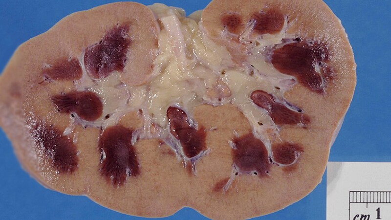 New AKI Risk Score for PCI Patients Passes Validation