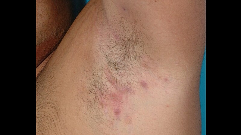 Adalimumab Enhances Primary Wound Closure After HS Surgery