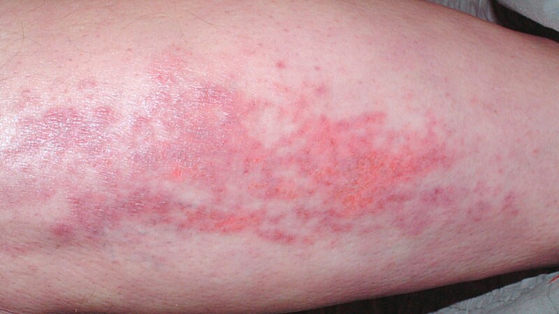 Dermatomyositis: Data Support IFN-Beta as Therapeutic Target