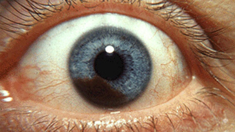 Benefits of Tebentafusp in Uveal Melanoma Last 3 Years