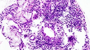 What's New in Sjögren Disease: Update From ACR 2021