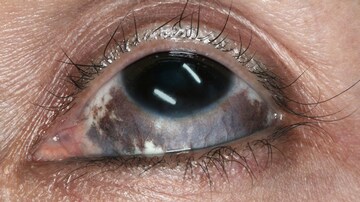 Laser Treatment of Nevus of Ota: Does It Work in Black Patients?