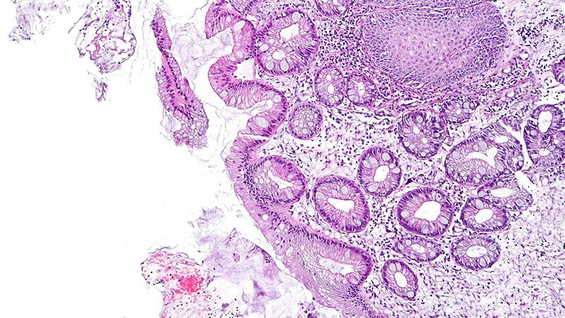 High Burden, Unclear Benefit of Barrett’s Screening in US 