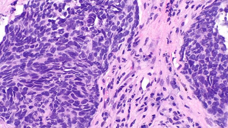 Certain NSCLC Subgroups May Not Benefit From Immunotherapy