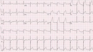 Half-dose TNK for STEMI Without Timely PCI: STREAM-2