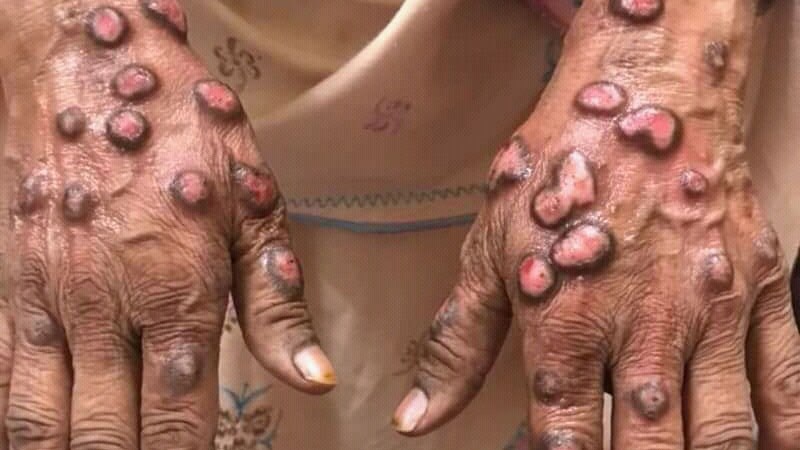 Phase 3 Prurigo Nodularis Trial Shows Benefit With Nemolizumab