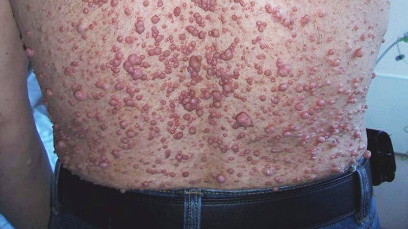 Study Compares Noninvasive Treatments of Cutaneous Neurofibromas