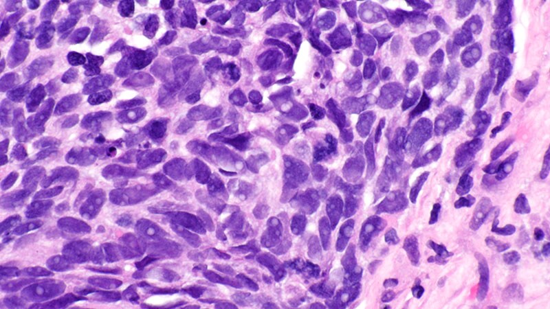 TLS in Tumors May Predict Immunotherapy Benefit in NSCLC